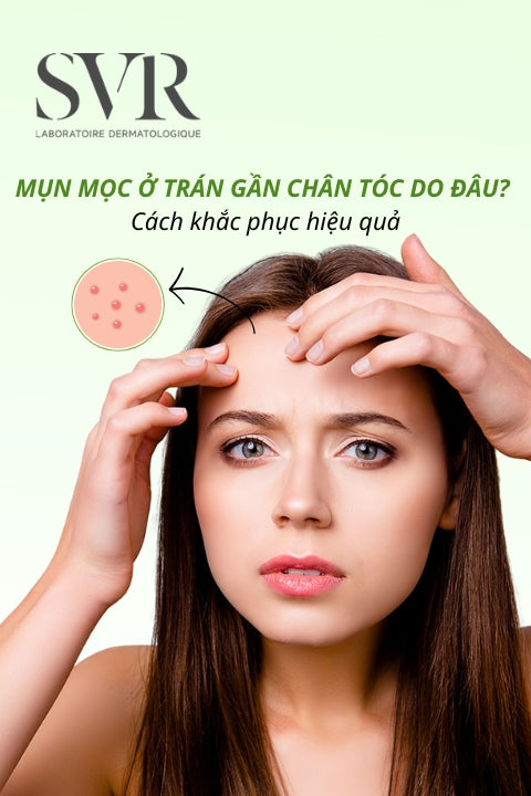 Mụn mọc ở trán gần chân tóc do đâu? Cách khắc phục hiệu quả