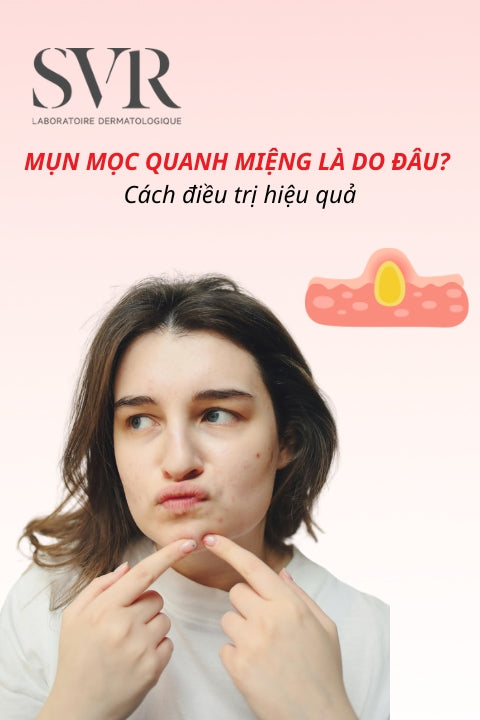 Mụn mọc quanh miệng là do đâu? Cách điều trị hiệu quả