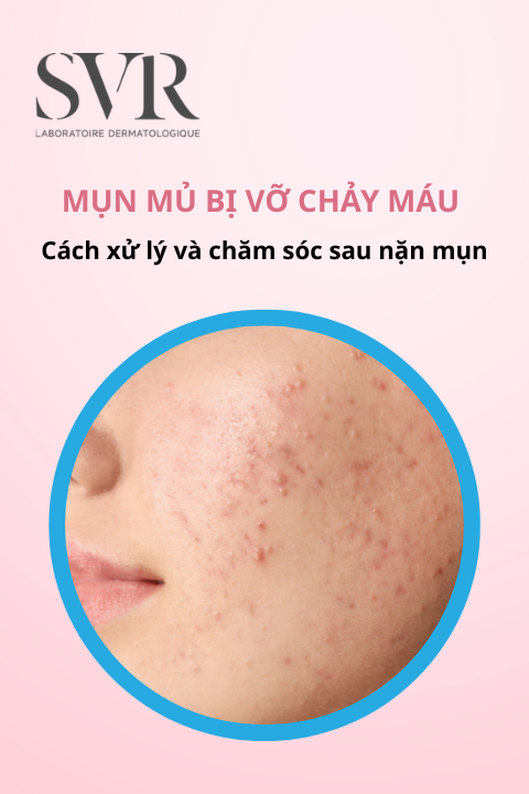 mụn mủ bị vỡ chảy máu