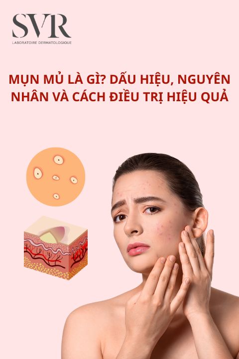 Mụn mủ là gì? Dấu hiệu, nguyên nhân và cách điều trị hiệu quả