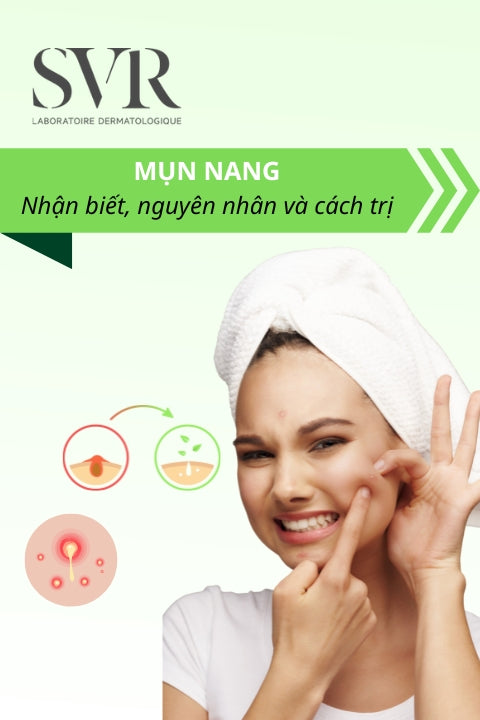Mụn nang là gì? Nguyên nhân và cách điều trị an toàn, hiệu quả