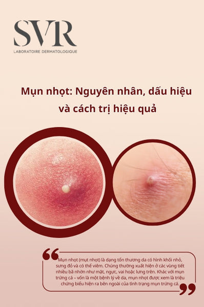 Mụn nhọt: Nguyên nhân, dấu hiệu và cách điều trị mụn hiệu quả