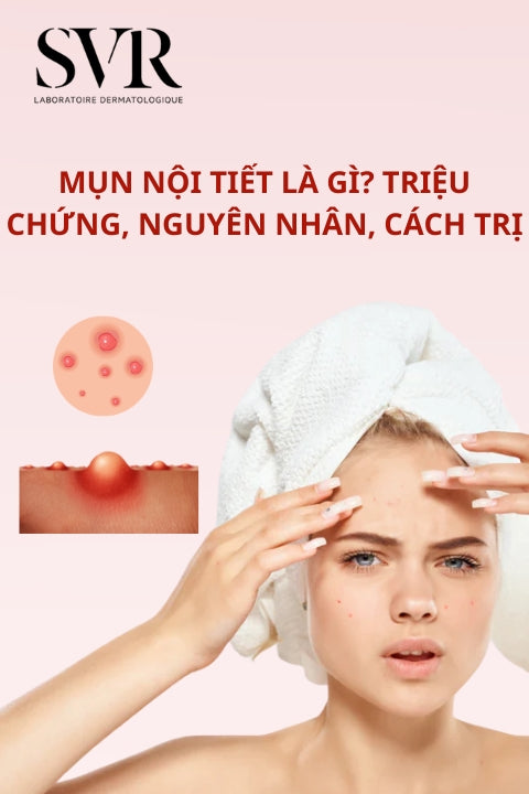 mụn nội tiết