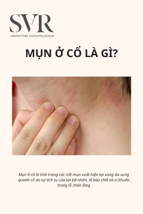 mụn ở cổ