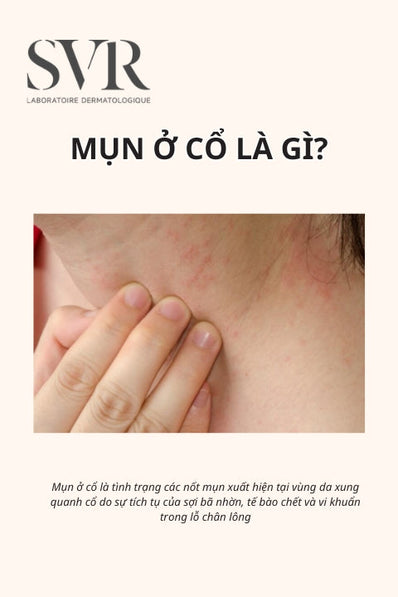 mụn ở cổ