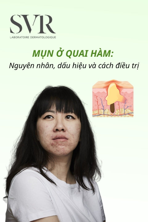Mụn ở quai hàm: Nguyên nhân, dấu hiệu và cách điều trị hiệu quả, an toàn