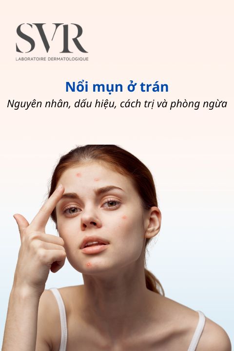 Nổi mụn ở trán: Nguyên nhân, dấu hiệu, cách trị và phòng ngừa