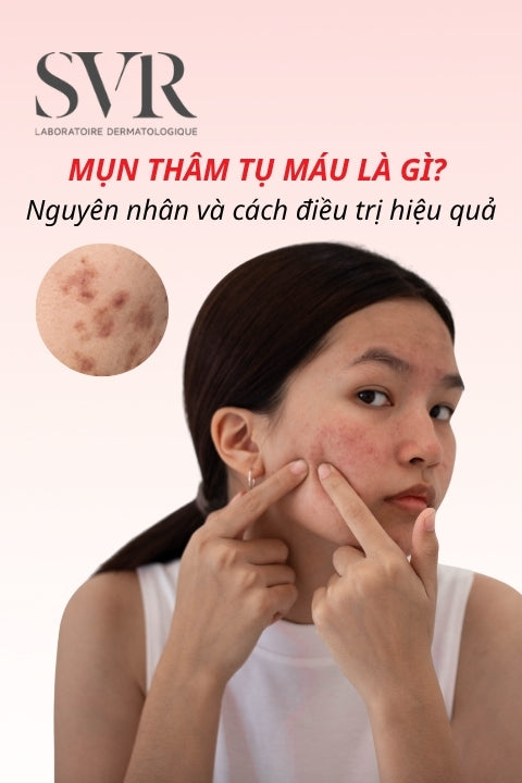 Mụn thâm tụ máu là gì? Nguyên nhân và cách điều trị hiệu quả