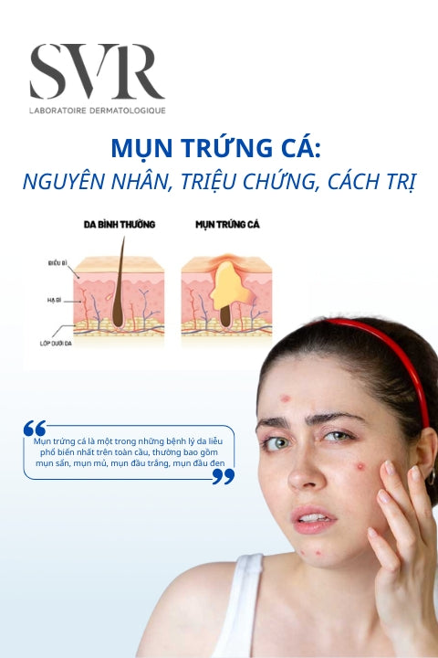 Mụn trứng cá là gì? Nguyên nhân, triệu chứng, cách điều trị hiệu quả