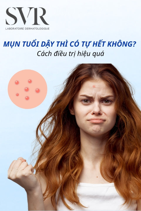 Mụn tuổi dậy thì có tự hết không? Bao nhiêu tuổi thì hết? Có nên nặn không?