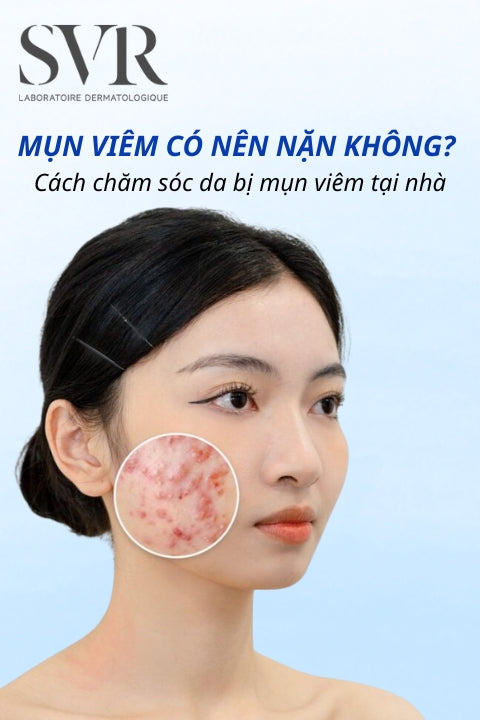 Mụn viêm có nên nặn không? Cách chăm sóc da bị mụn viêm tại nhà