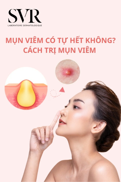 Mụn viêm có tự hết không? Cách trị mụn viêm hiệu quả, nhanh chóng
