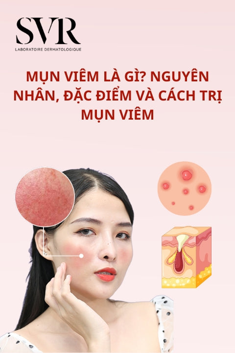 Mụn viêm là gì? Nguyên nhân, đặc điểm và cách trị mụn viêm