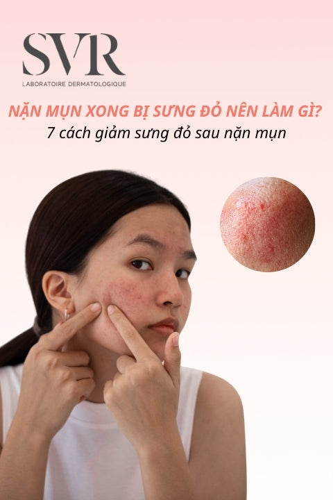 Nặn mụn xong bị sưng đỏ nên làm gì? 7 cách giảm sưng đỏ sau nặn mụn