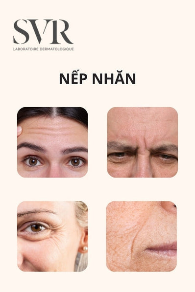 Nếp nhăn là gì? Nguyên nhân, dấu hiệu nhận biết và cách giảm nếp nhăn tại nhà