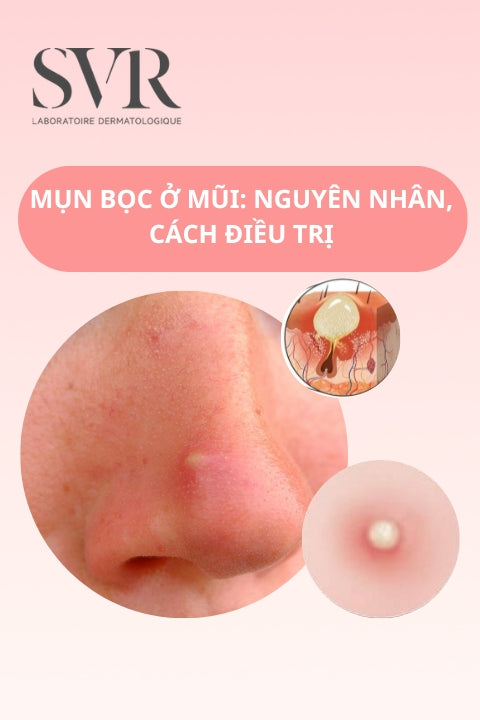 nguyên nhân gây mụn bọc ở mũi