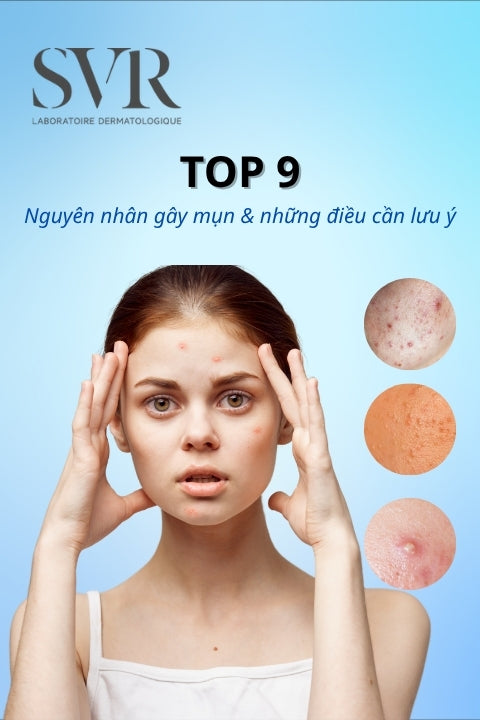 Top 9 Nguyên nhân gây mụn phổ biến và những điều cần lưu ý