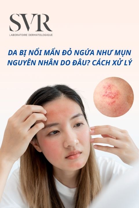 Da nổi mẩn đỏ ngứa như mụn: Nguyên nhân, cách khắc phục hiệu quả