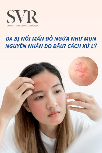 Da ngứa gãi nổi hột, mẩn đỏ như mụn: Nguyên nhân và cách xử lý