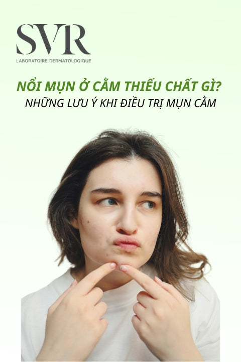 Nổi mụn ở cằm thiếu chất gì? Những lưu ý khi điều trị mụn cằm