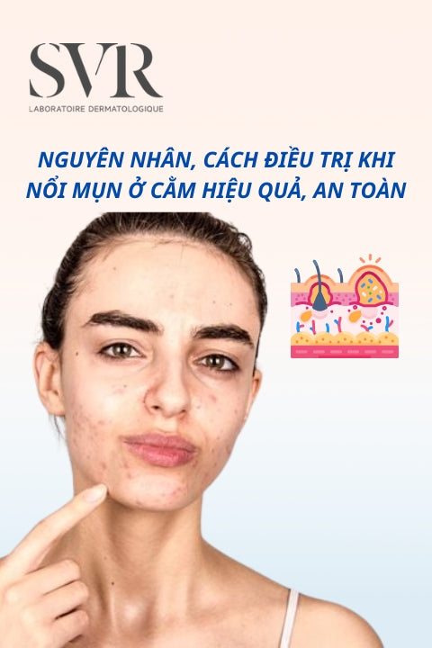 Nguyên nhân, cách điều trị khi nổi mụn ở cằm hiệu quả, an toàn