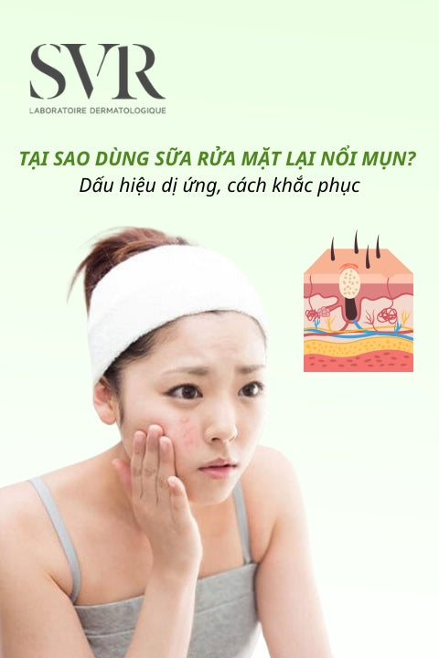 Tại sao dùng sữa rửa mặt lại nổi mụn? Dấu hiệu dị ứng, cách khắc phục