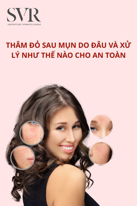 thâm đỏ sau mụn