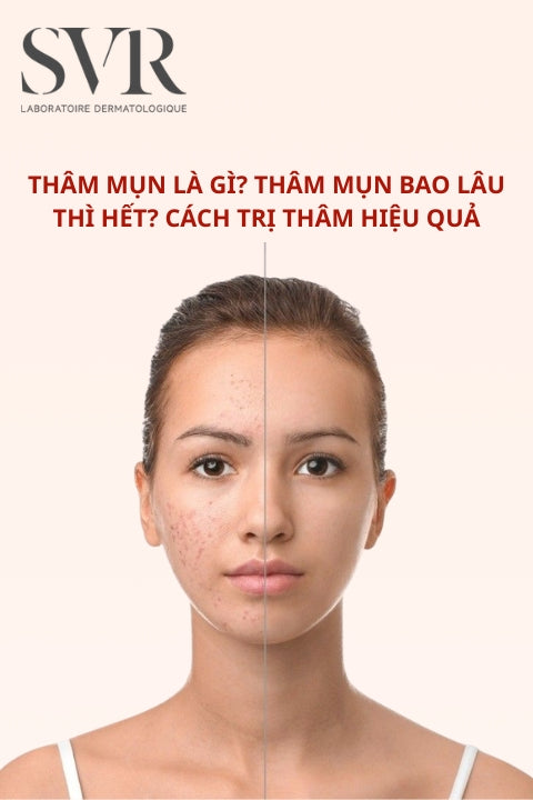 Thâm mụn là gì? Thâm mụn bao lâu thì hết? Cách trị thâm hiệu quả