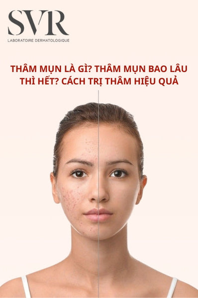 Thâm mụn là gì? Thâm mụn bao lâu thì hết? Cách trị thâm hiệu quả