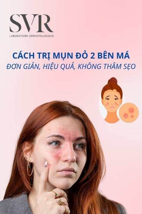 cách trị mụn đỏ 2 bên má