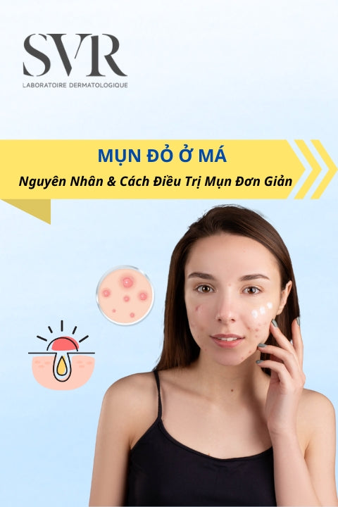 mụn đỏ ở má