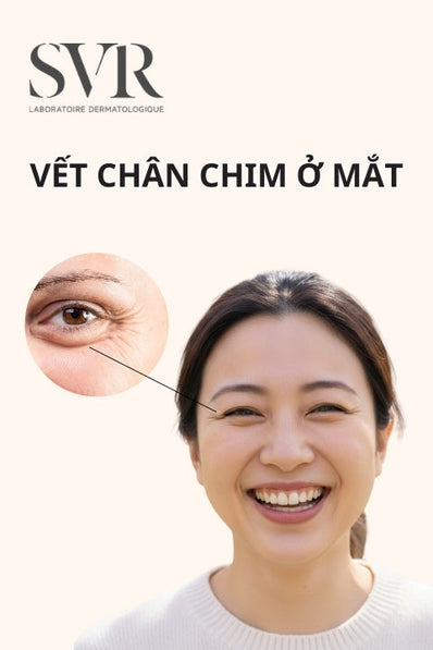 Vết chân chim