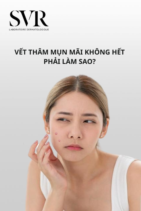 Vết thâm mụn mãi không hết phải làm sao? Nguyên nhân và cách điều trị