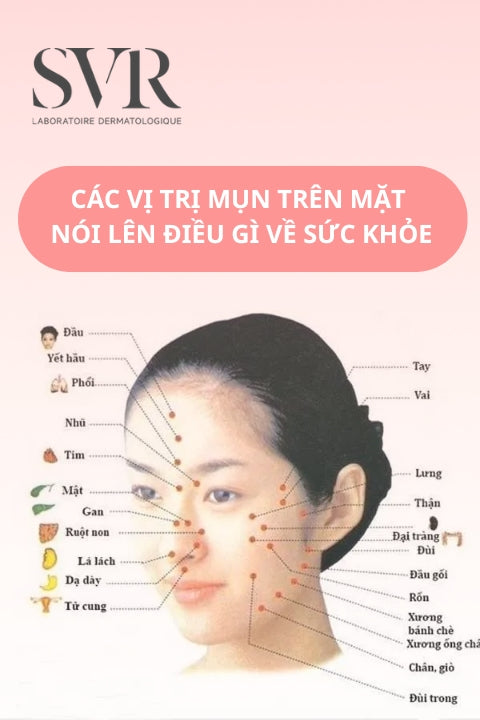 vị trí mụn