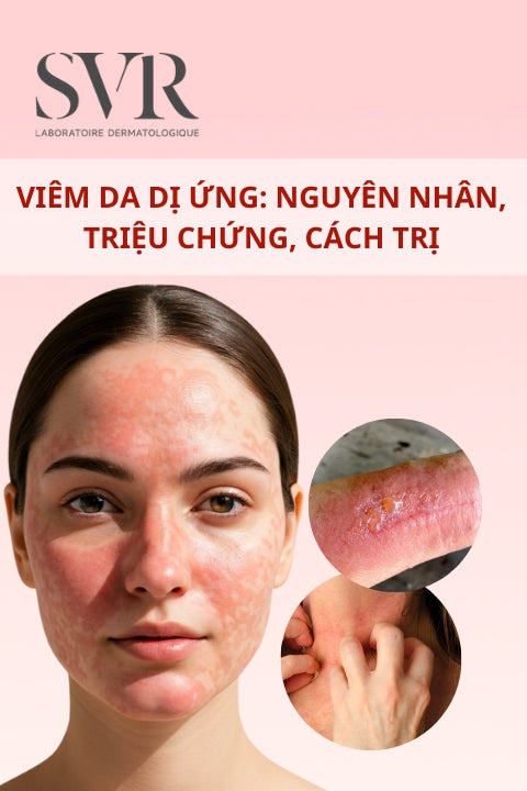 Viêm da dị ứng: Nguyên nhân, triệu chứng, cách trị và phòng ngừa