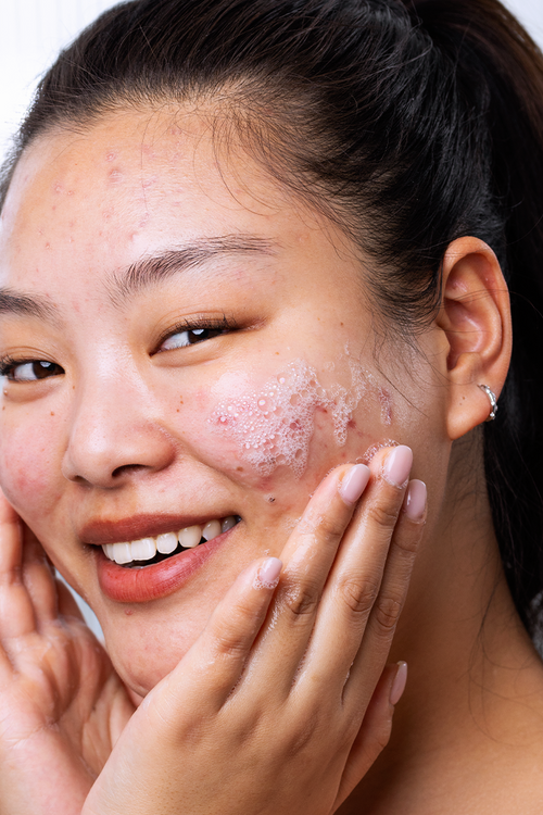 Gel Rửa Mặt Cho Da Dầu Mụn SVR Sebiaclear Gel Moussant